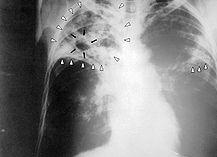 Radiografía-TB.JPG