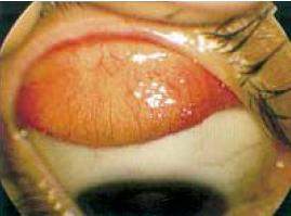 Enfermedad tracoma.jpg