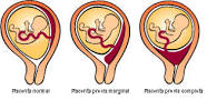 Placenta marginaljc1.jpg