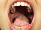 Mucositis oral.jpg