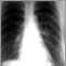 Coccidiomicosis pulmonar crónica.jpg