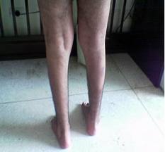 Distrof muscul becker.jpeg