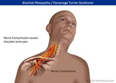 El dolor puede extenderse al cuello, brazo inferior .jpg