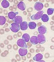 Leucemia linfositica.jpg