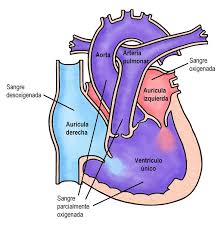 Corazón univentricular.jpg