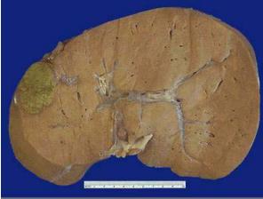 Angioma hepático.JPG