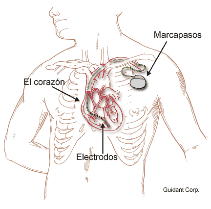 Archivo:Marcapaso.gif