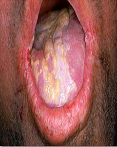 Candidiasis.jpg