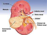 Cancer-renal-rinon-pelvis.jpg