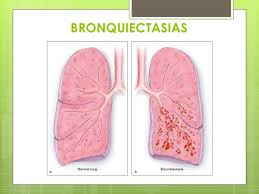Bronquiectasias.jpg