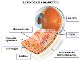 Retinop-diabét 2.jpeg