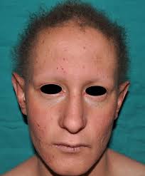 Displasia facial hectod. congénita.jpg