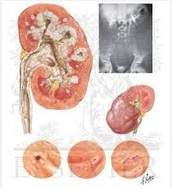 Tuberculosis urogenital.jpg