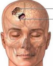 Fractura cráneo.jpeg