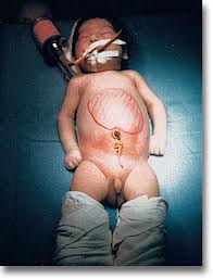 Cirrosis hepática neonatal.jpg
