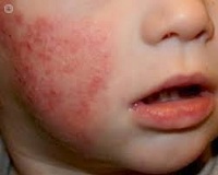 Dermatitis atópica en la infancia.jpg