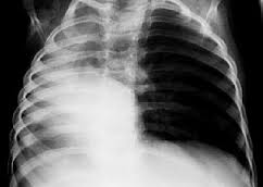 Agenesia pulmonar.jpg