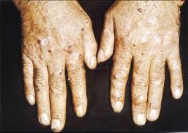 Archivo:Porfir-intermit-aguda 2.jpeg