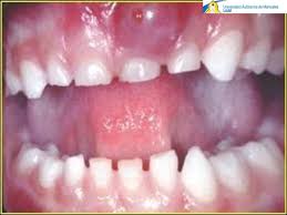 Absceso periodontal.jpg