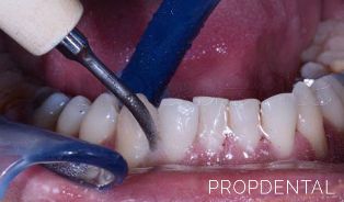 Limpieza-dental.jpg
