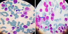 Leucemiacelulas.jpg