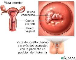 Cáncer cérvico uterino.jpeg
