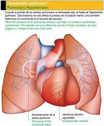 Hipertensión de los pulmones.jpg