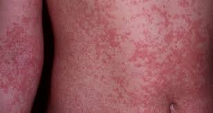 Archivo:Rash cutáneo del zika.jpeg