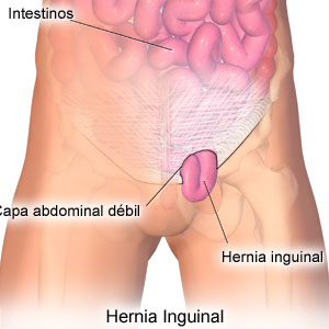 H. Inguinal.jpeg