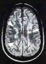 Enfermedad de Binswanger EcuRed