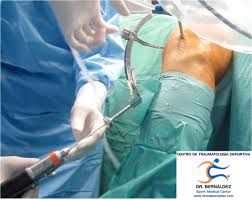 Osteocondral Autólogo.jpeg