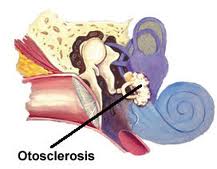 Otosclerosis.jpg