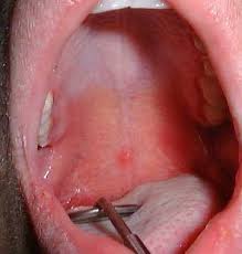 Sífilis de la laringe.jpg