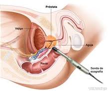 Biopsia próstata.jpg ‎  ‎