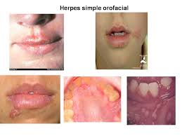 Herpes simple1.jpg
