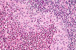 245px-Langerhans cell histiocytosis - very high mag.jpg
