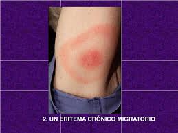 Eritema crónico migratorio.jpg