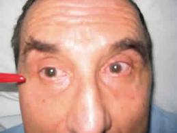 Oftalmoplejia images.jpeg