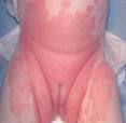 Dermatitis de Pañal.jpg