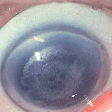 Schnyder corneal dystrophy 1.JPEG