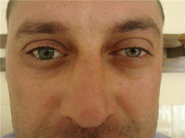 Archivo:Paciente con prótesis ocular.jpg