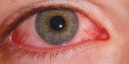 Alergias oftalmologicas.jpg