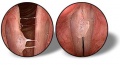 00015108ic laryngitis1.JPG