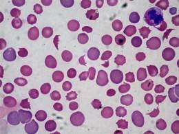 Anemia hemolítica inmunitaria.jpg