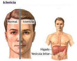 Encefalopatía hepática (Small).jpg