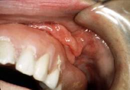 Dentures - Wikipedia