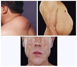 Lipodistrofia-asociado-al-vih-sida.jpg