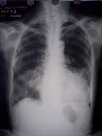 1-bronconeumonía 1.jpg
