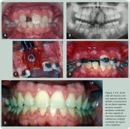 Dientes restenidos.jpg