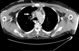 Fibrosis mediastínica.jpg